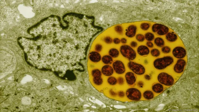 Tanpa pengobatan, penyakit kelamin Klamidia bisa menyebabkan kemandulan.