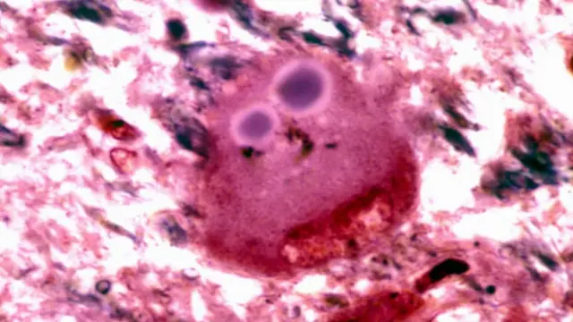 سلول عصبی (قرمز) و دو توده لوی در داخل آن (بنفش)