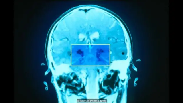  疲劳可能源自基底神经节受损。该图显示一名帕金森症患者的大脑，此处标出的就是基底神经节。（图片来源：Science Photo Library）