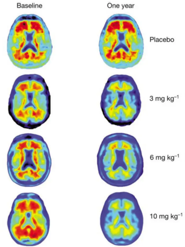 اسکن مغز تاثیر دوزهای متفاوت دارو را بعد از یک سال درمان نشان میدهد