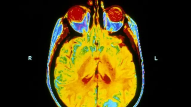 تُعالج أورام المخ الثانوية في مرضى سرطان الرئة عادة بالعلاج الإشعاعي لكامل المخ.
