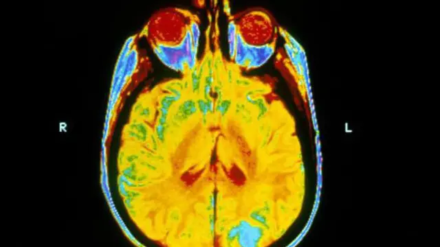 د دماغ بشپړه رادیوتراپي ځکه تر سره کېږي، چې فکر کېږي دې سره تومر کنترولیږي
پولا ملوینا