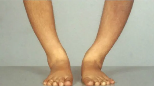 缺乏维生素D ，会导致骨质变薄、变软、变稀疏。骨头会变得脆弱甚至变形。人体内长期缺乏维生素D，可导致儿童患佝偻病，老人容易骨折。