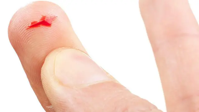 Панариций: Лечение воспаления пальцев — Сеть МЦ «Доктор Боголюбов»