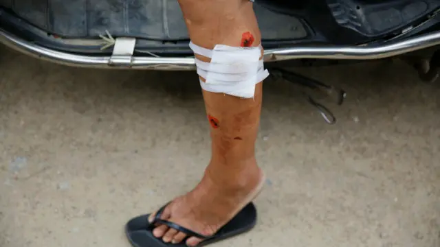 乌坎村内一名妇女腿上已包扎的伤口（14/9/2016）