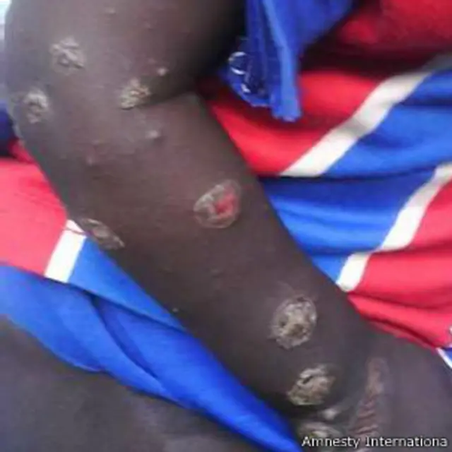 ذراع طفل تظهر عليها تقرحات تقول المنظمة إنها من جراء استخدام أسلحة كيماوية