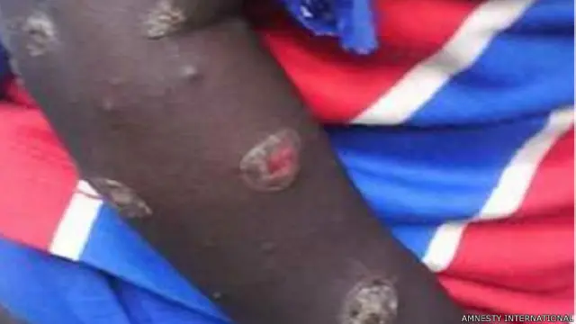 Chemical weapon victim