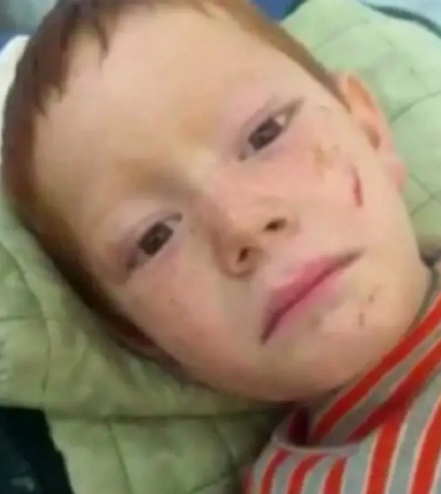 هذا الطفل يعاني من إصابة في العمود الفقري بسبب القصف.