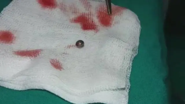 这枚集束弹钢珠是从伤者肝脏中取出的