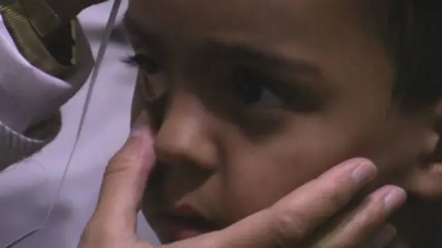 العديد من أطفال مضايا يعاني سوء التغذية ولم يعد بمقدورهم السير بصورة صحيحة