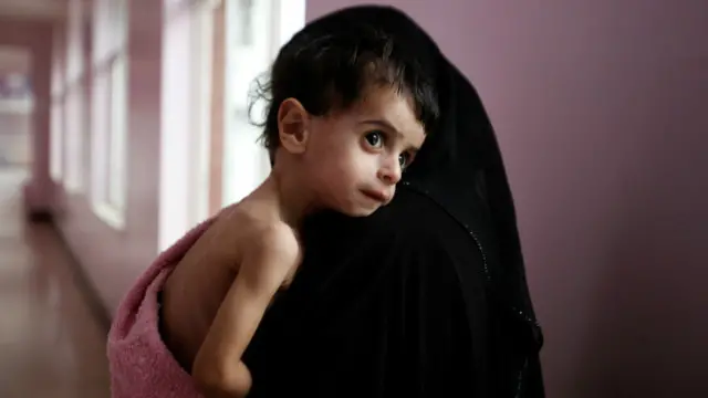 الأمم المتحدة أكدت منذ أيام تفشي وباء الكوليرا في اليمن.