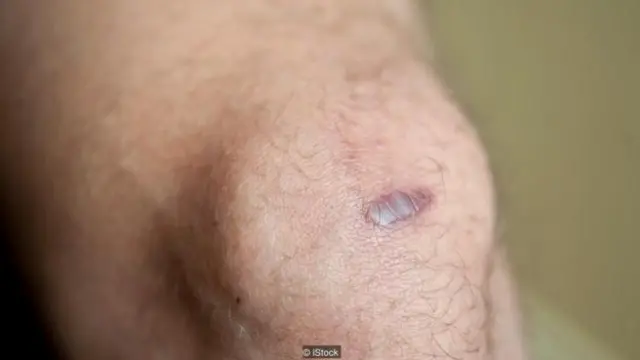 雖然血痂能夠保護傷口免受感染，但卻是形成瘢痕的罪魁禍首。(圖片來源: iStock)