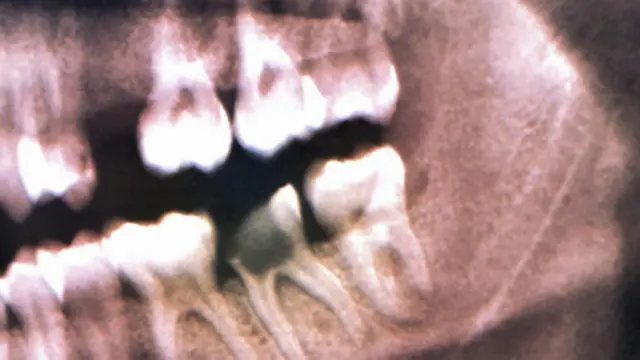 现如今，可通过 X 射线发现龋齿（图片来源：Zephyr/SPL）