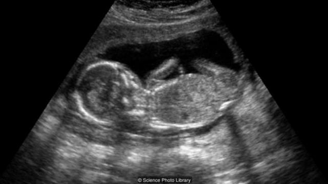 心脏仍跳动的尸体或能够维持胎儿生长。(图片来源: Science Photo Library)