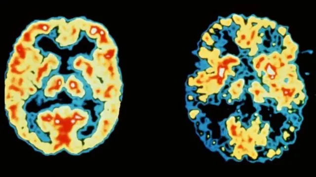 الزهايمر أكثر أنواع الخرف شيوعا