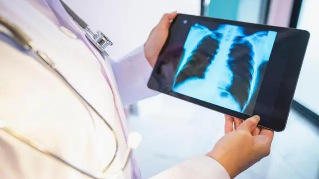 ਫੇਫੜਿਆਂ ਦਾ ਐਕਸਰੇ