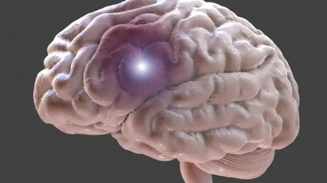 Aworan ọpọlọ eeyan