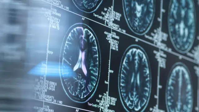 Мээдеги уктап жаткан вирустардын активдүүлүгү Альцгеймер оорусунун өнүгүшү менен түздөн-түз байланыштуу болушу мүмкүн