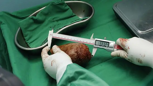 சிறுநீரகக்கல், அறுவை சிகிச்சை, இலங்கை ராணுவம் 