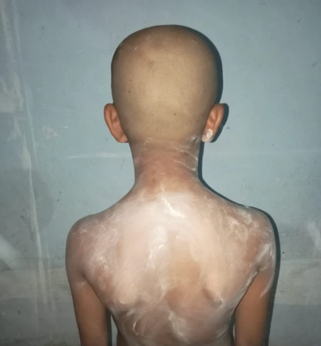 Tubuh bocah laki-laki tersebut dilumuri bedak demi meredakan perih akibat cabai. 