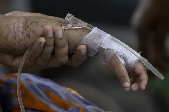 হামে আক্রান্ত একটি শিশুর হাত ধরে রেখেছেন একজন