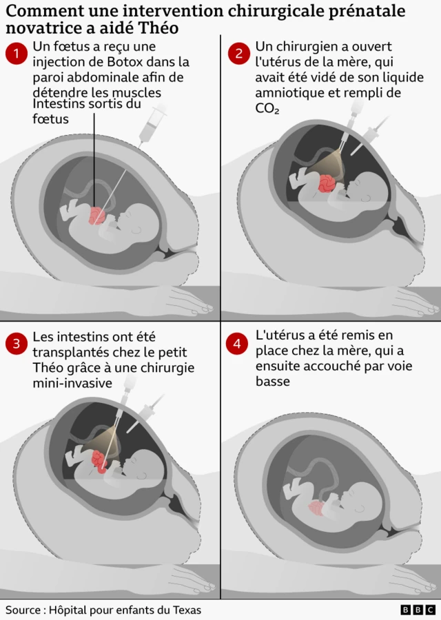 Infographie illustrant une intervention chirurgicale prénatale en quatre étapes. Le fœtus reçoit une injection de Botox dans la paroi abdominale afin de détendre les muscles ; les chirurgiens ouvrent temporairement l'utérus et, par chirurgie mini-invasive, remettent les intestins du fœtus à l'intérieur de son corps avant de refermer l'utérus, ce qui permet à la grossesse de se poursuivre jusqu'à la naissance naturelle d'un bébé en bonne santé.
