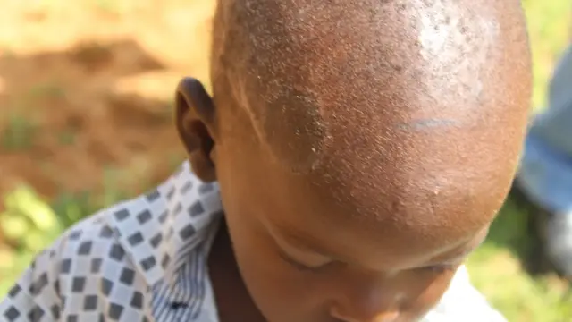 ህጻናት ብዝተፈላለዩ ክድሕኑ ዘይክአሉ ሕማማት ቆርበት ይጥቅዑ