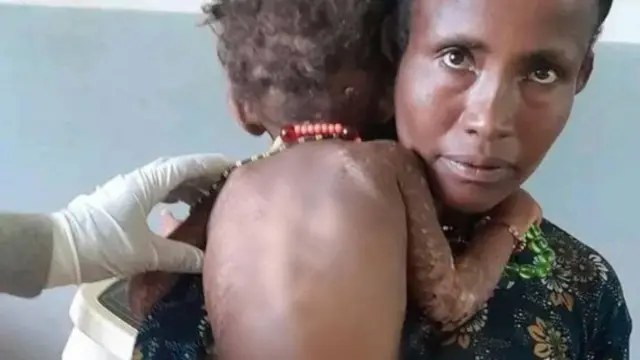 Daa'ima hanqina nyaataafi dhukkubaan miidhamte
