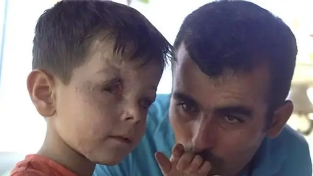 Jouma dan ayahnya yang hancur jari-jari kakinya dalam serangan udara itu.