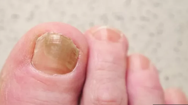 Mbọ na-etoba n'akpụkpọ ahụ