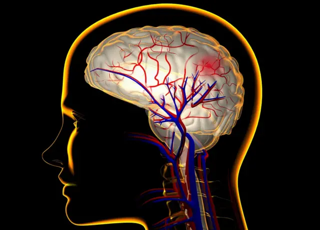ब्रेन स्ट्रोक