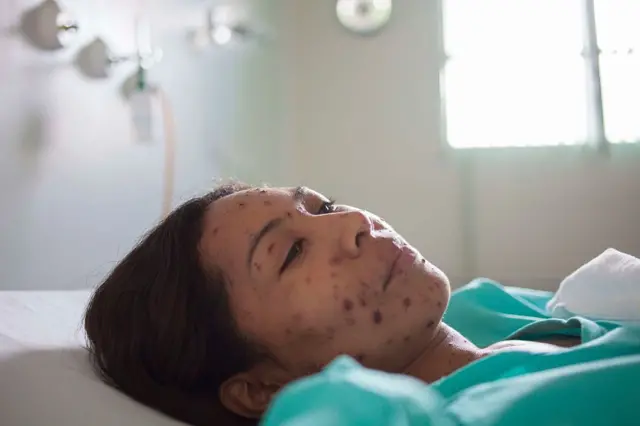 Жінка, хвора на кір, лежить на ліжку