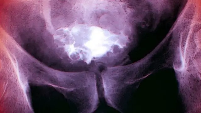 سرطان المثانة