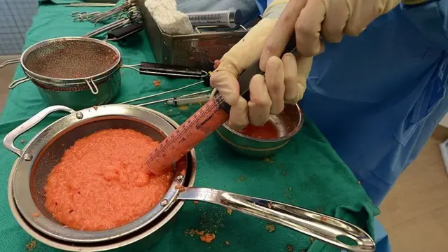 Инъекция жира в ягодицы