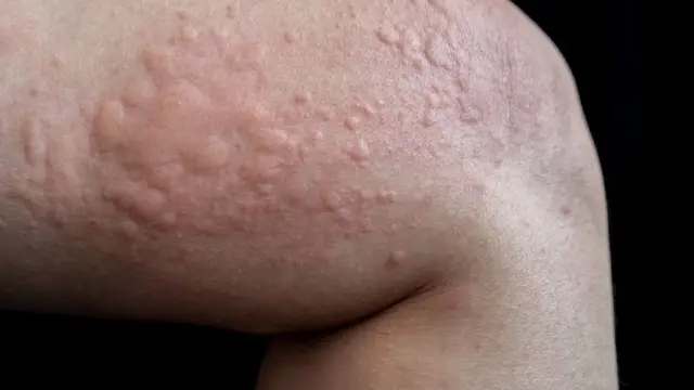 کهیر/حساسيت