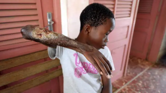 Хлопчик у західноафриканській країні Кот-д'Івуар показує наслідки захворювання на виразку Бурулі