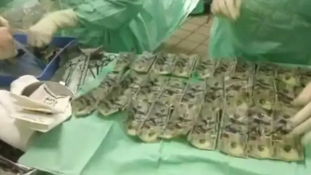 வயிற்றில் இருந்து எடுக்கப்பட்ட பணநோட்டுக்கள்