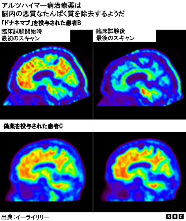 アルツハイマー病新薬「ドナネマブ」、世界的な臨床試験で効果