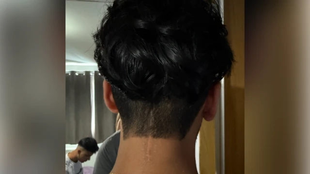 La cabeza negra de un joven con cabello oscuro y largo. En la parte superior del cuello, paralela a la columna vertebral, hay una cicatriz blanca y recta con otros puntos cicatriciales a ambos lados.