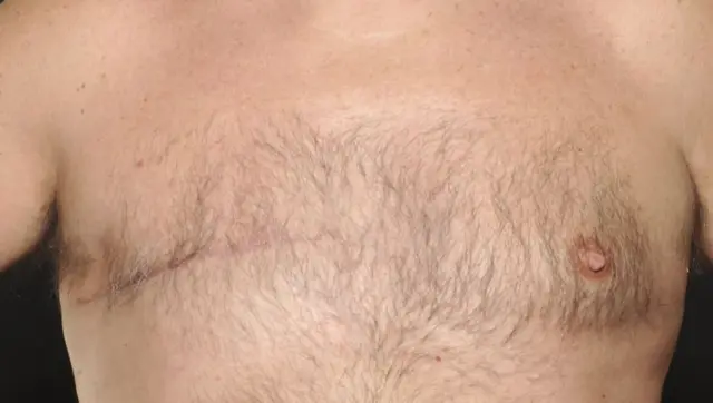 जाइल्स कूपर, पुरुषों में स्तन कैंसर