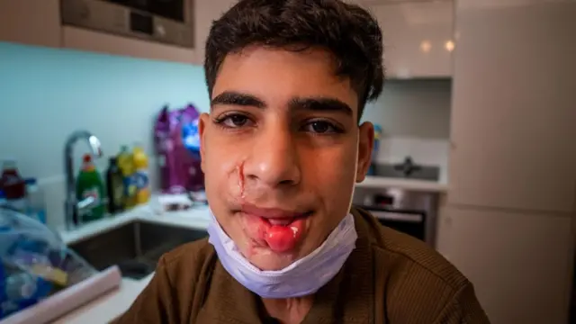 صورة لماجد توضح إصابة فكه وشفتيه
