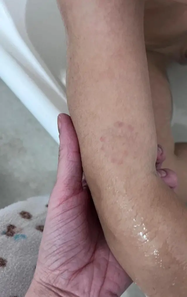 Foto de um braço de criança com uma marca redonda no que parece ser uma mordida.