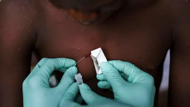 ఎంపాక్స్ 