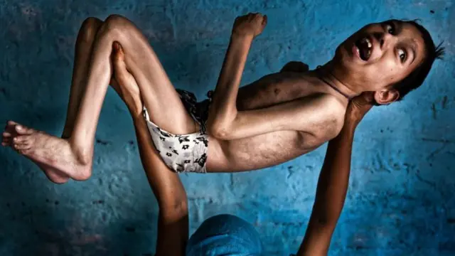 Bhopal gas victim Samir held up by his mum