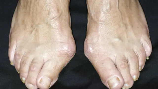 Onye nwere ókpúkú na mkpísí úkú ya