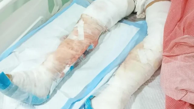 மனித சதையை உண்ணும் பாக்டீரியாவால் சிறுவன் காலை இழந்தானா?