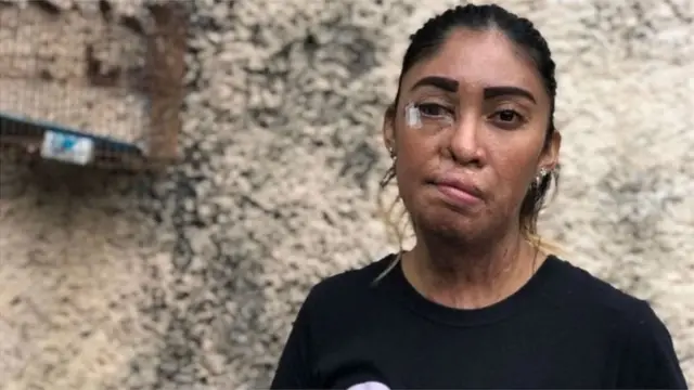 ઍસિડહુમલાની પીડિતા