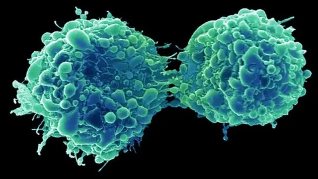 Un virus du rhume a infecté et tué des cellules cancéreuses de la vessie dans l'étude.