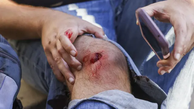 Нога человека со следом от резиновой пули