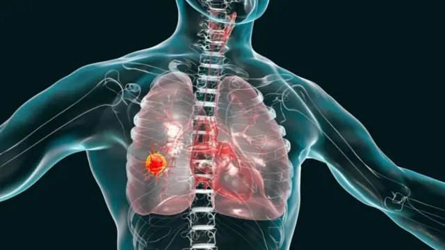 ਫੇਫੜਿਆਂ ਦਾ ਕੰਪਿਊਟਰ ਨਾਲ ਤਿਆਰ ਗਰਾਫਿਕਸ